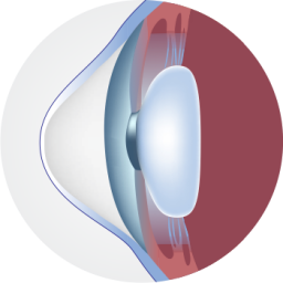 keratoconus_cornea | Keratoconus Institute of Maryland