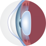 normal_cornea | Keratoconus Institute of Maryland