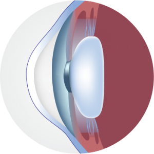 normal_cornea | Keratoconus Institute of Maryland