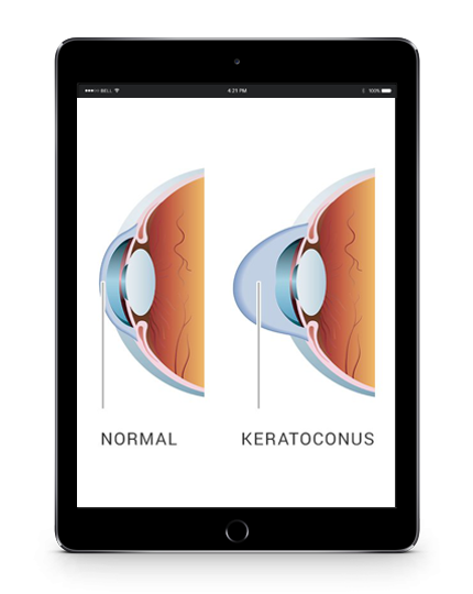 What is Keratoconus? Diagram illustrating a normal eye and a keratoconus eye.